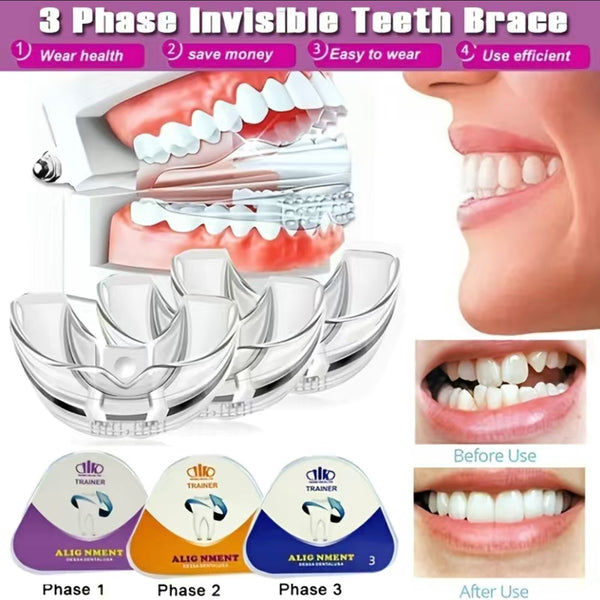 Invisalign invisible orthodontics in Paris- Dental alignment